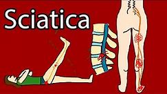 Sciatica - One-sided Leg pain and tingling. Sciatica Symptoms and Treatment. Radiculopathy