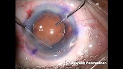 Smart toric IOL: customised toric IOL for correcting 10D astigmatism by Dr Sourabh D Patwardhan