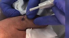 Warts on hand removal by radiosurgery at Cosmedics Skin Clinics London & Bristol