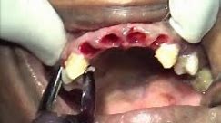 Full mouth teeth extraction for all on 6 dental implant procedure
