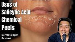 Salicylic Acid Peels | Indications