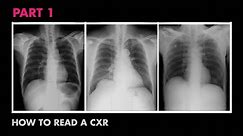 Anatomy of a Chest X-Ray - How to Read a Chest X-Ray (Part 1)
