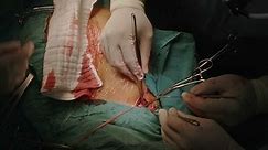 surgeon use ring PTFE graft bypass subclavian artery