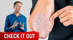 A Great Psoriasis Remedy
