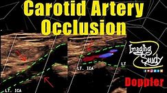 Carotid Artery Occlusion || Doppler || Ultrasound || Case 266