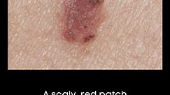What do basal cell and squamous cell skin cancers look like?