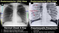 Chest X-Ray Lung Normal Vs Abnormal Image Appearances Part 1 | TB/Pneumonia/Consolidation/Collapse