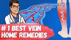#1 Best Varicose Vein Home Remedies [Spider Veins in Legs Treatment]