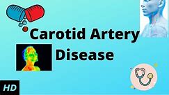 CAROTID ARTERY DISEASE, Causes, Signs and Symptoms, Diagnosis and Treatment.