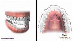 How Invisalign or Clear Aligners work - Orthodontic Treatment