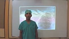 Dr Pradip Patil Surgery for Fractures of Clavicle D Y Patil Medical College, Kolhapur