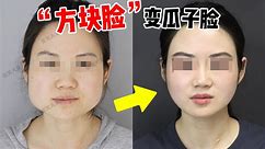 【张笑天】“方块脸”变瓜子脸，下颌角术后1年复查，“难以置信变化这么大！！！”