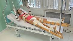 Vintage Splints and Traction on Double Plaster Leg and Arm Casts