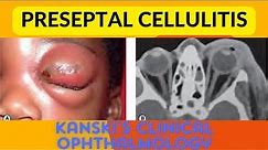 Preseptal cellulitis-Kanski's clinical ophthalmology #eyelid infection #abscess #eye swelling