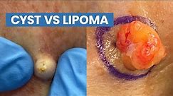 Cyst vs Lipoma (Short Pops Compilation) | CONTOUR DERMATOLOGY