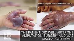 Man has his arm amputated after sushi dish leads to flesh-rotting ulcers