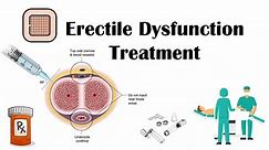 How To Treat Erectile Dysfunction? Treatment Of Erectile Dysfunction