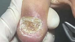 Fungal nail treatment, watch till end to see what treatment I used.