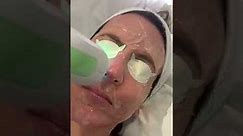 Part 3: Dr Malcolm Willis performs the Rosacea treatment with Harmony XL Pro | Laser Clinic Norwich