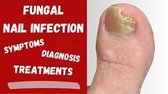 Fungal Nail Infection, Causes, Symptoms, Diagnosis and Treatment