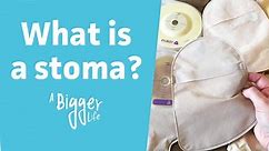 What is a stoma? | The ABC of ostomy