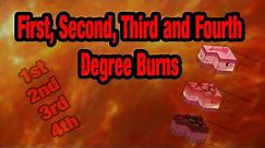 How To Grade BURNS - 1st, 2nd, 3rd and 4th Degree Burns Explained