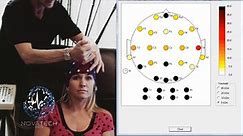 Instructional Series on Quantitative Electroencephalography & Neurofeedback