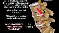 Sciatica causes, Clinical Diagnosis and treatment.