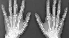 X-ray (Radiography) - Bone