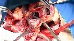 Heart Transplant Surgery (Cardiac Transplant) | A Complete Video