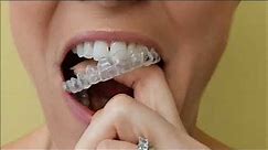 How to remove your Invisalign Aligners