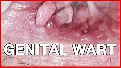 Genital Warts in Men: Causes, Symptoms and Removal