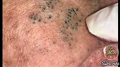 Dr Pop - Deep Blackheads in old Skin removing & treatment 2020 (Part 4) HD