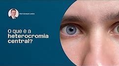 O que é a heterocromia central? O acumulo de cor na íris! - Prof Edomar Cunha #iridologia