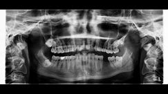 🦷👉 POD MIKROSKOPEM: Czy leczony kanałowo ząb zatruwa organizm, dlatego że jest martwy?