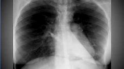 Chest x-ray --Pneumomediastinum