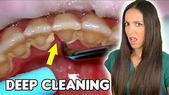Deep Cleaning With HEAVY Tartar Build Up At The Dentist