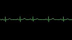 Ecg Animation Premature Ventricular Contraction Vpc Stock Footage Video (100% Royalty-free) 1085074781 | Shutterstock