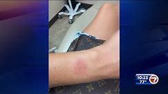 Fort Lauderdale claims Apple Watch left burn on her arm