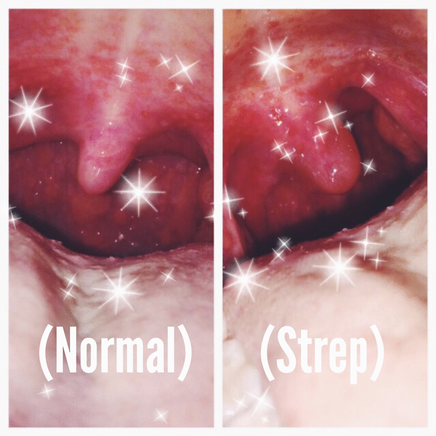 Symtoms Of Strep Throat 16
