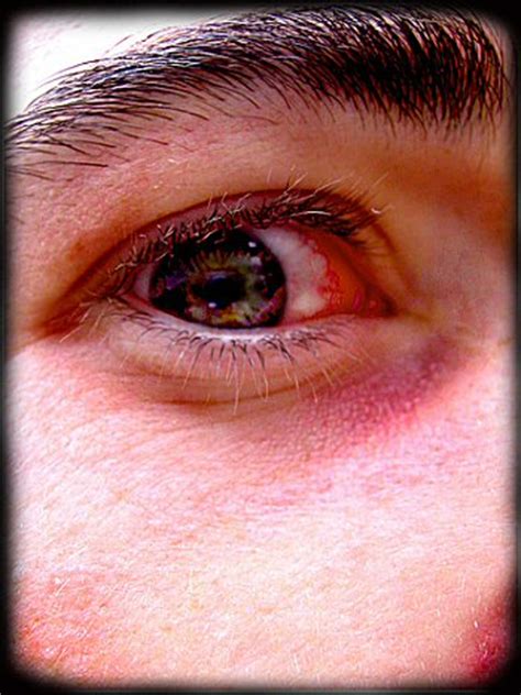 pictures  pink eye