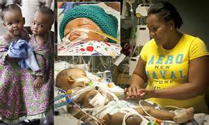 Conjoined Twins Maria And Teresa Tapia Separated After 20