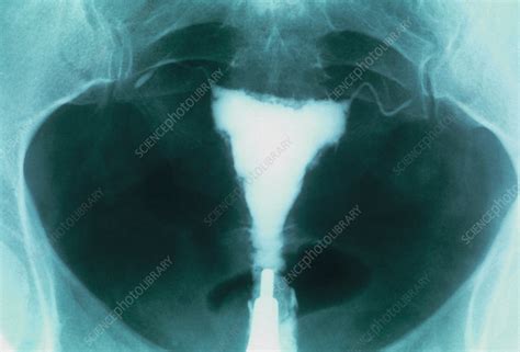 post menopausal uterus x ray stock image p616 0331