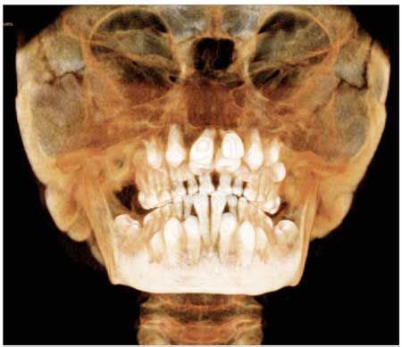 ray  skull dentadura