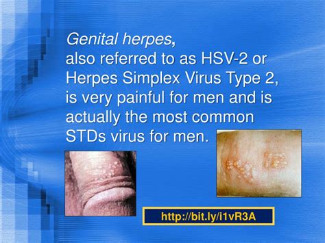 ppt male genital herpes remedy pictures photos