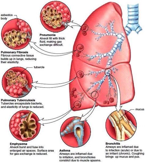 Lung Diseases Respiratory Therapy Pulmonology Medical Anatomy