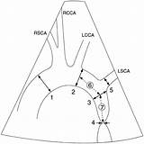 Aortic Coarctation Aorta Echocardiographic Outcome Angioplasty Predicts Quantitative Analysis sketch template