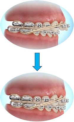 effects  wearing elastics rubber bands  braces braces