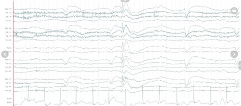 Ultimate Guide To The Eeg Test Seer Medical