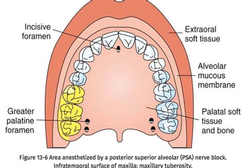 posterior superior alveolar nerve    properly anesthetize